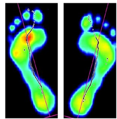 Curafoot Clinic: Foot Scanning and Pressure Point Analysis Diagnostics ...