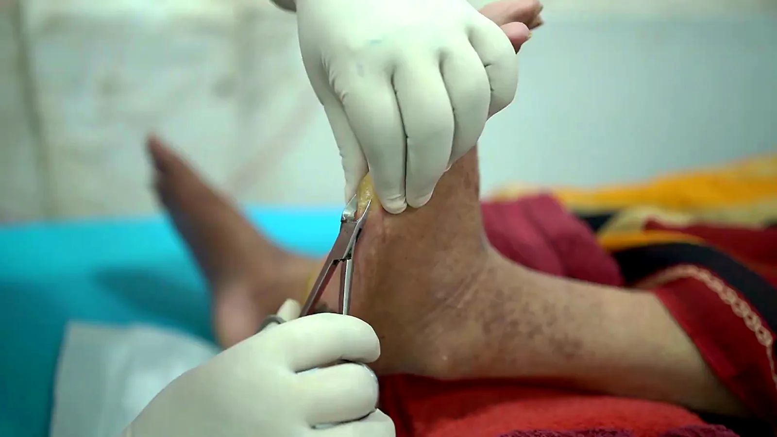 Podiatrist working on the back of the heel at CuraFoot