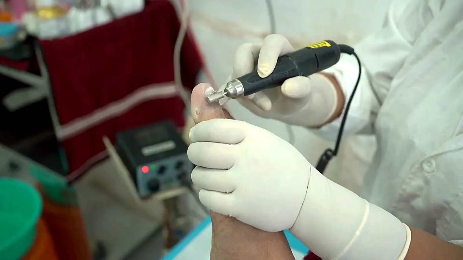 Toenail treatment with a podiatry drill at CuraFoot