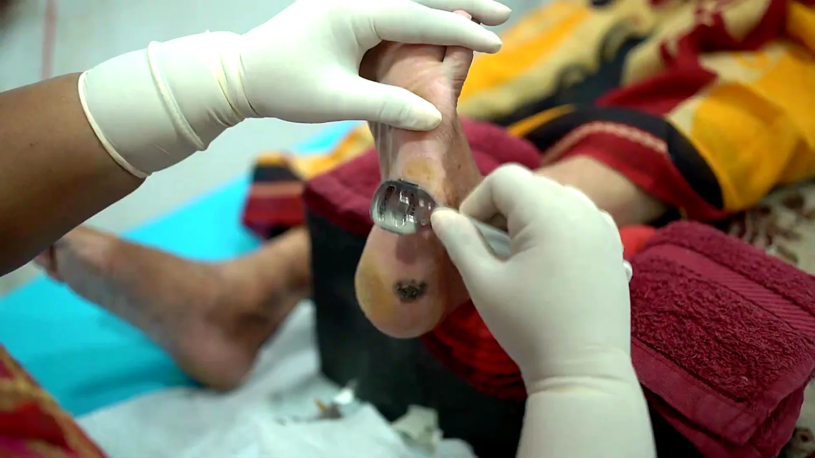 Callus treatment on the sole at CuraFoot