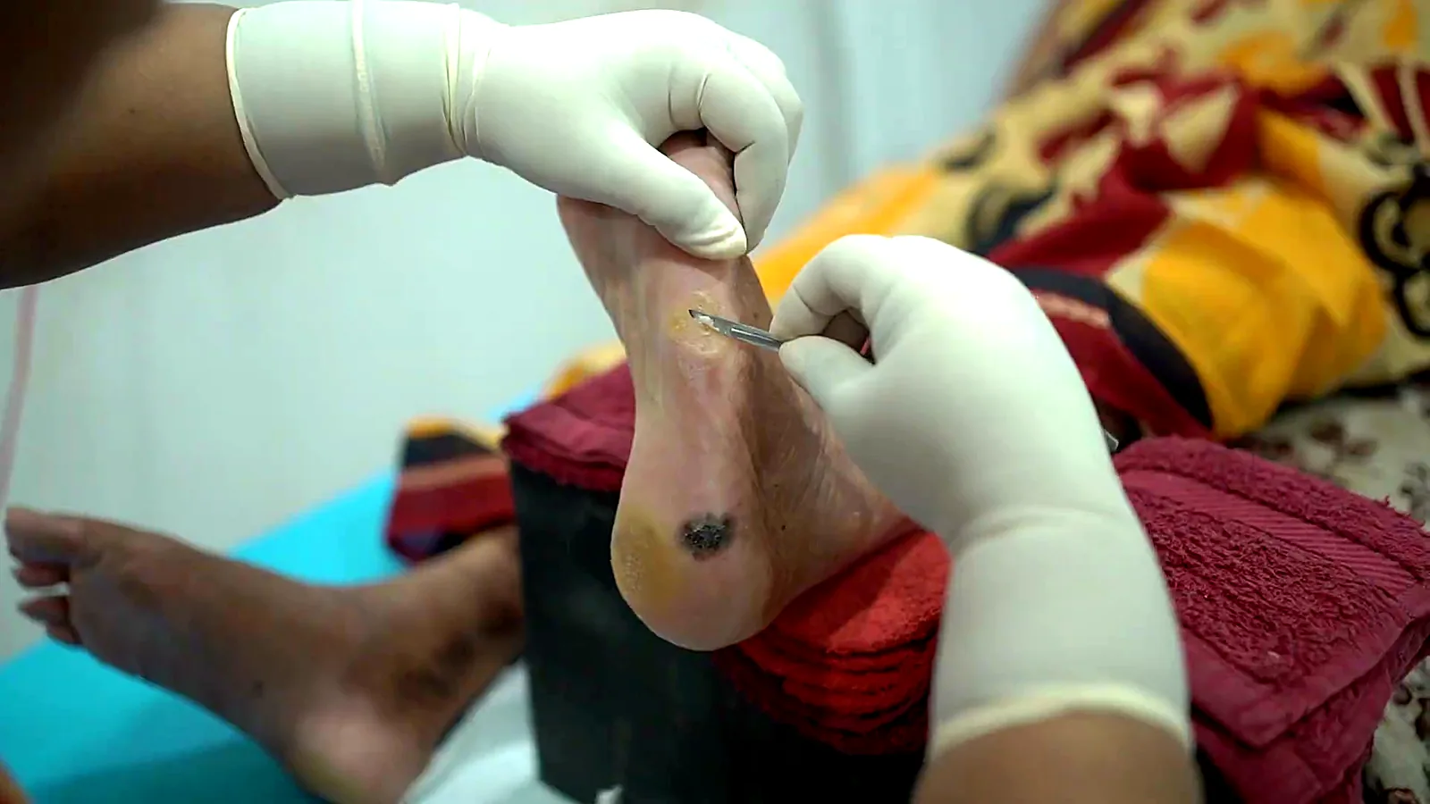 Corn removal on the sole of the foot at CuraFoot